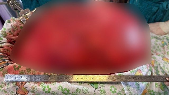 Кубанские хирурги удалили у пациента 17-килограммовую опухоль
