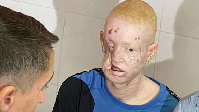 Хирурги Краснодара единственные в мире смогли вернуть лицо альбиносу из Африки Фото: краевая БСМП