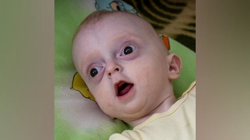 Уральскому ребенку с редким синдромом Крузона нужна сложная операция в Москве