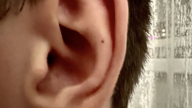 Китаянка после травмы пять месяцев ходила с пересаженным ухом на ноге 