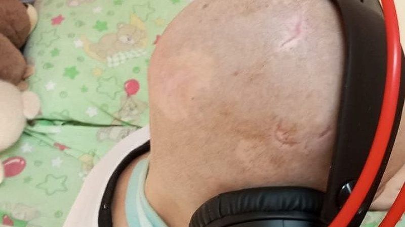 Покусанного хаски мальчика из Сочи подготовили к установке эспандеров