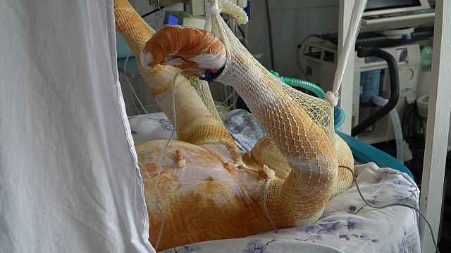В Краснодаре провели уникальную операцию женщине, получившей 30% ожогов после хлопка газа Фото: Телеканал «Краснодар»