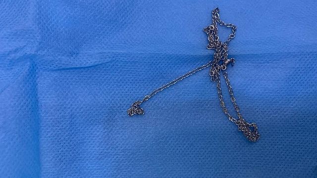 Из желудка 6-летнего мальчика достали цепочку врачи Туапсе