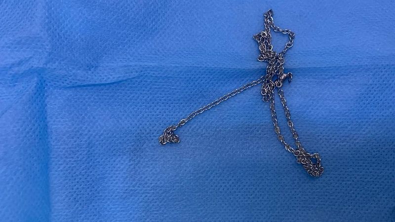 Из желудка 6-летнего мальчика достали цепочку врачи Туапсе