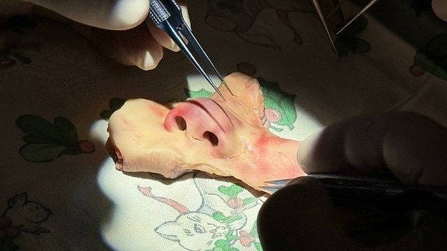 Краснодарские хирурги пришили половину лица мальчику после нападения собаки