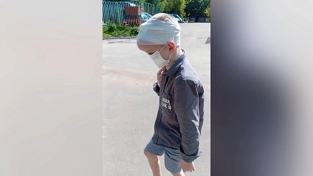 Прижились ткани на новом носу у искалеченного собаками мальчика из Сочи