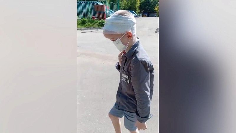 Прижились ткани на новом носу у искалеченного собаками мальчика из Сочи