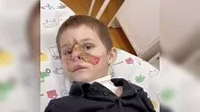 Мальчику с пришитым после нападения собаки лицом пересадили кожу с руки на веко 